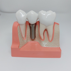 Maxi Implantat/Bro Studiemodel 